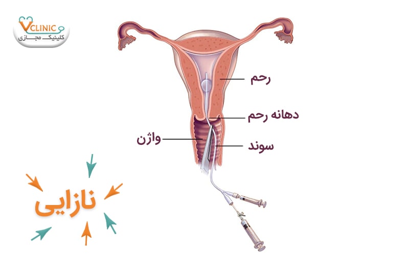 تشخیص نازایی زنان با هیستروسالپینگوگرافی