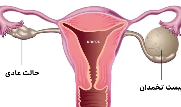 کیست تخمدان
