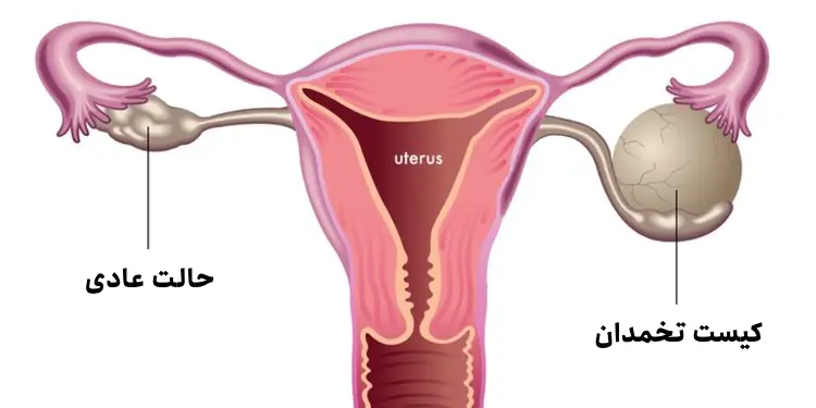 کیست تخمدان