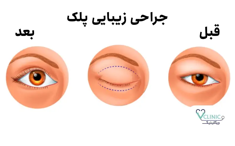 تصاویر قبل و بعد از جراحی زیبایی پلک