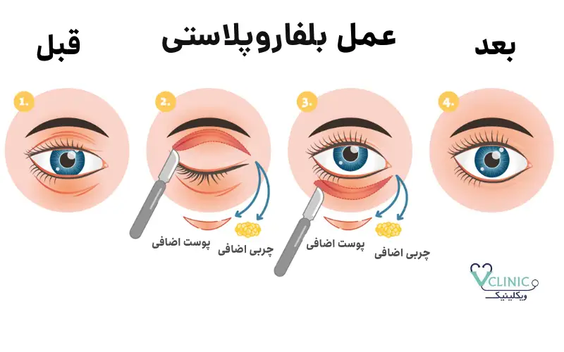 قبل و بعد از عمل بلفاروپلاستی