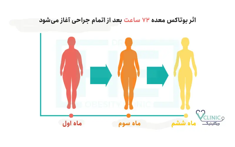 اثر بوتاکس معده بر روی وزن