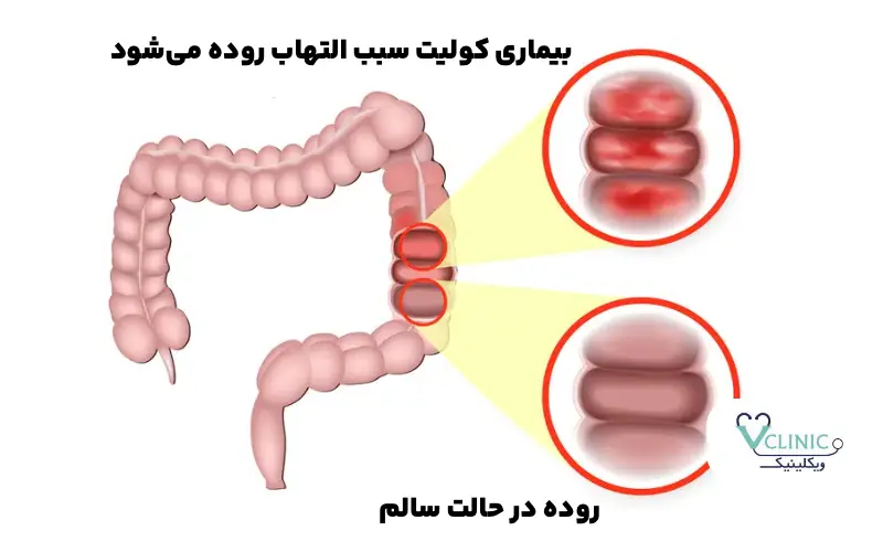 بیماری کولیت روده