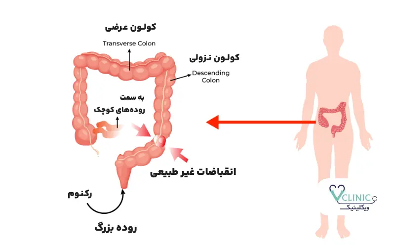 سندروم روده تحریک پذیر