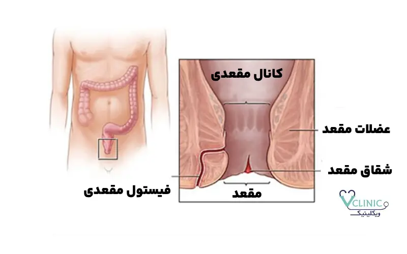 فیستول مقعدی