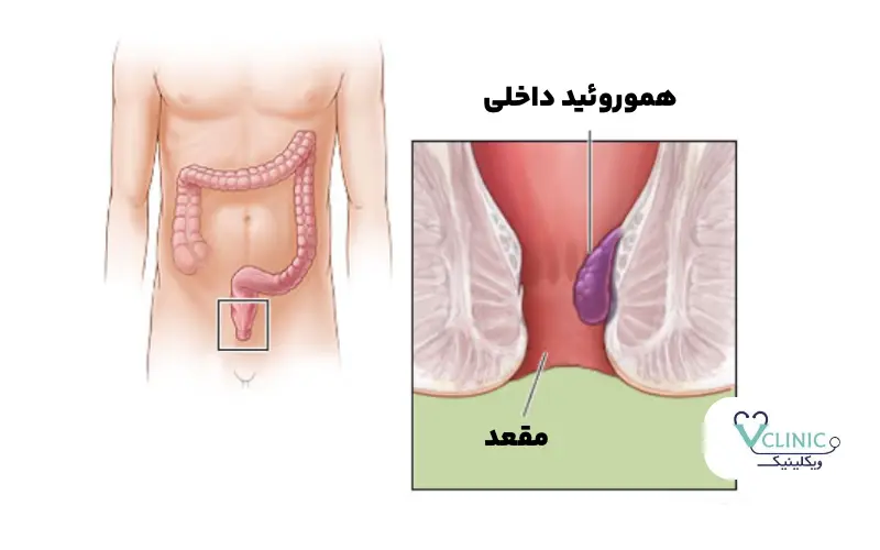 هموروئید داخلی یا بواسیر