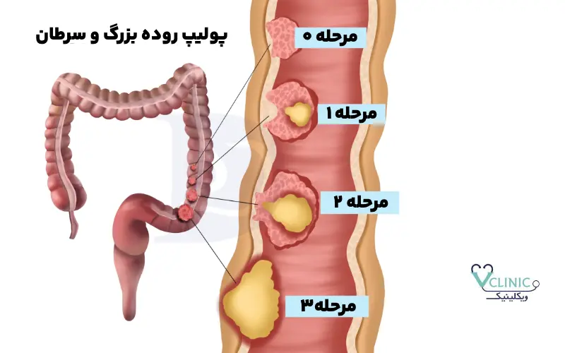 پولیپ روده بزرگ