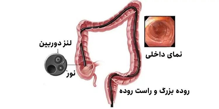فیلم عمل /جراحی کولونوسکوپی