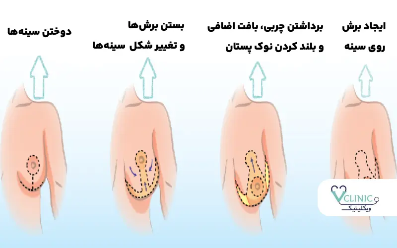 انواع عمل سینه (ماموپلاستی کاهشی)