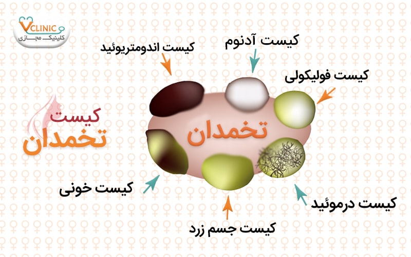 انواع کیست تخمدان