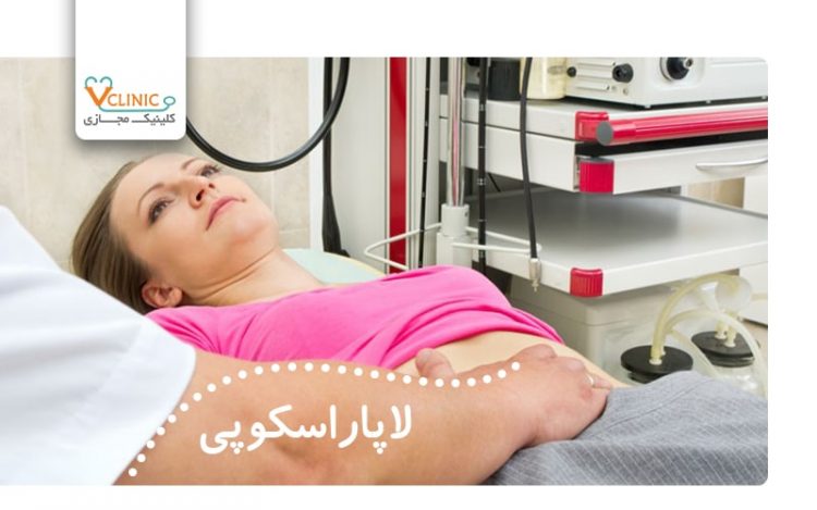 بعد از لاپاراسکوپی